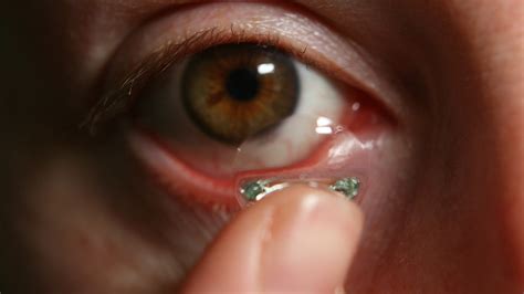 Doctors Report Removing 27 Contact Lenses From A Womans Eye Mpr News