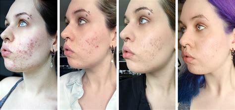 Post Acne Hyperpigmentation Causes Treatments And Prevention Justinboey