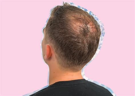 Hair Thinning Causes Male Going Bald Too Young Ohio State Medical