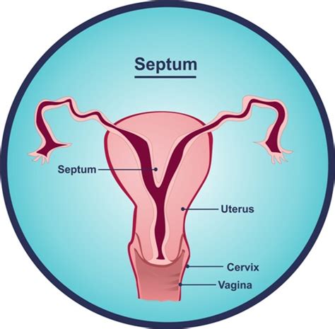 What Is A Uterine Septum