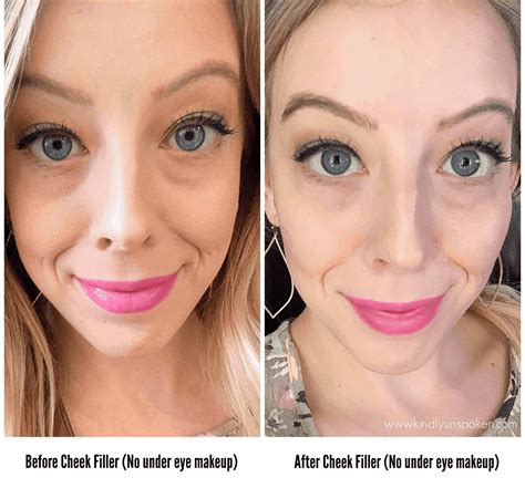 Under Eye Fillers For Dark Circles Before And After Kindly Unspoken