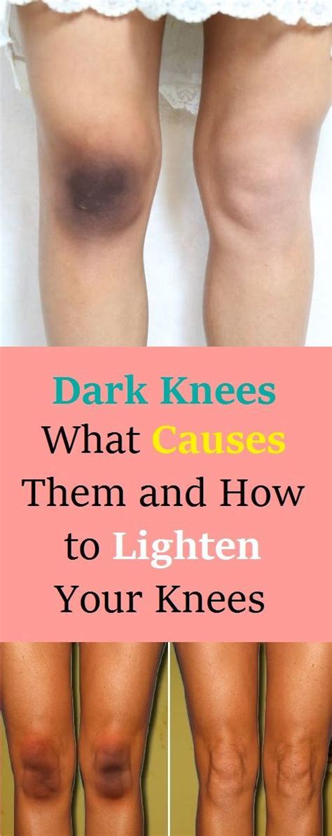 Having dark elbows and knees can be really embarrassing which is why we have searched for these few effective products to helps get rid of them. Dark Knees: What Causes Them and How to Lighten Your Knees ...