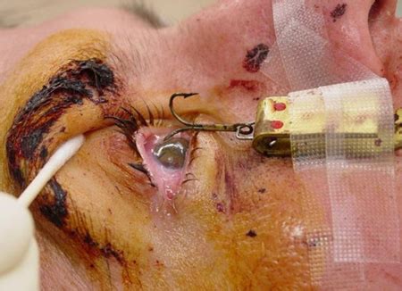To reduce the risk of injury: The Worst Fishing Injuries I Have Ever Seen