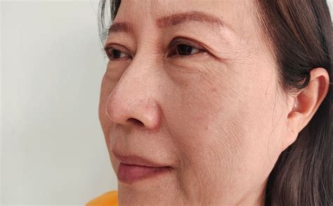 The Wrinkle And Blemish On The Cheek Ptosis And Flabby Skin Beside The