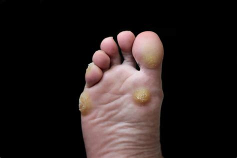 Ever Wondered About Callus On Your Feet Round House Podiatry