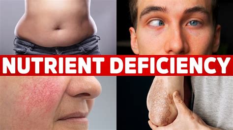 13 Signs Your Body Is Deficient In Nutrients Safer Pain Management