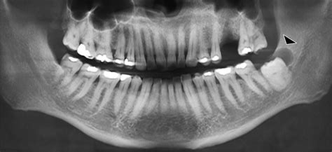 Quiste Paradental Dento Metric Radiología Dental Oral Y Maxilofacial