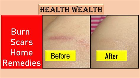 Burn Scars Treatment Burn Scars Removal Get Rid Burns Scars Marks