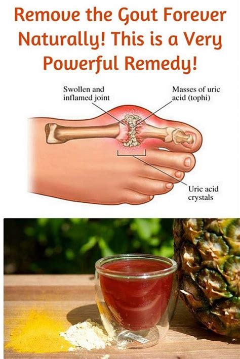 Remove The Gout Forever Naturally This Is A Very Powerful Remedy