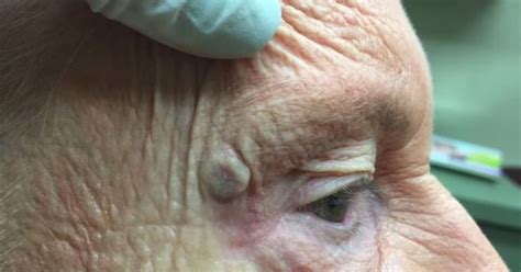 dr pimple popper tackles massive blackhead in gross yet oddly mesmerising video huffpost uk life