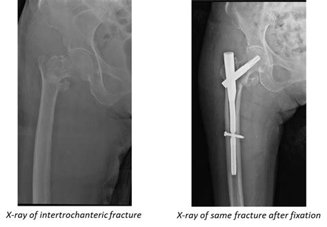Hip Fracture Surgery For Elderly Singapore Minimally Invasive Procedure