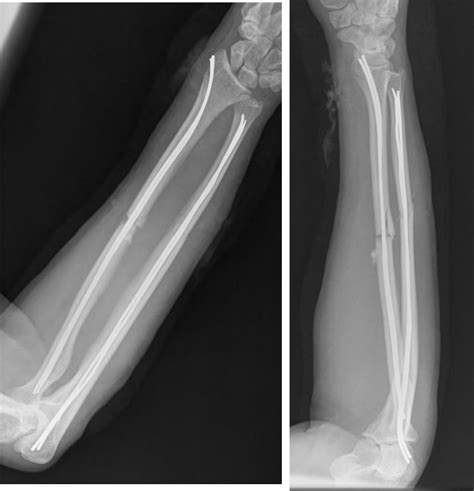 Stacked Flexible Nailing For Radius Ulna Fractures Fig 2 Journal Of