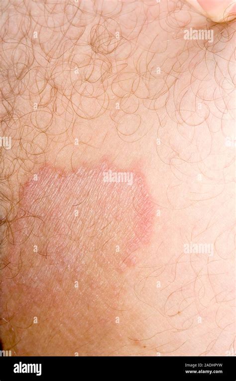 Model Released Ringworm Infection On A 22 Year Old Mans Groin A