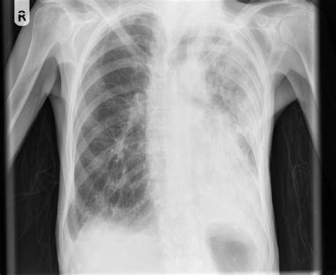 Aspergillosis Chest X Ray Wikidoc