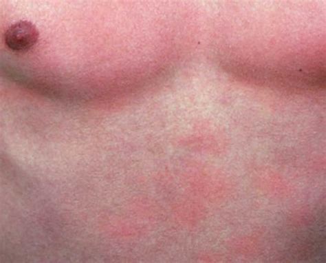 Prickly Heat Rash Miliaria Causes Types Prevention And Treatment
