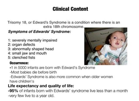 Pin By Nonas Arc On Trisomy 18 Aka Edwards Syndrome Edwards Syndrome