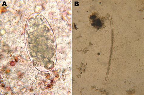 Figure Trichostrongylus Colubriformis Nematode Infections In Humans
