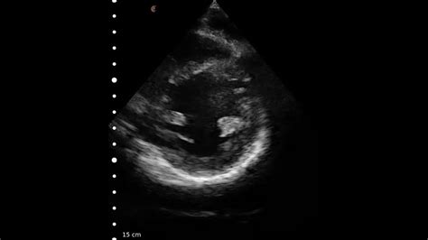 Cardiac Echography Clarius Portable Ultrasound Youtube