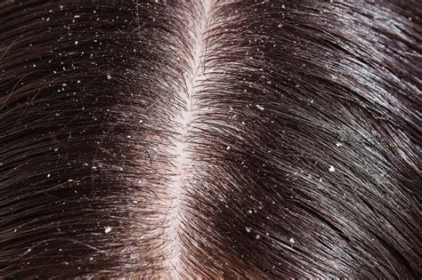 Dandruff Common Chronic Scalp Condition Marked By Flaking Of The Skin