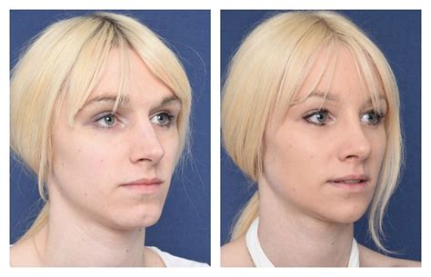 Pin On Facial Feminization Surgery Transformations 2018