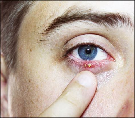 Close Up Man S Eye Ophthalmologic Disease Hordeolum Eye Doctor