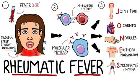 Rheumatic Fever Made Easy Including Jones Criteria And Mnemonic