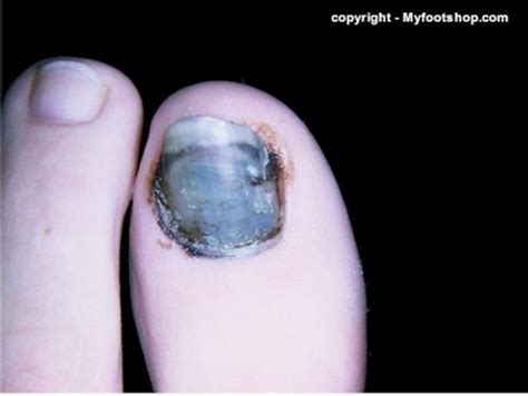 Toe Nail Injuries Causes And Treatment Options
