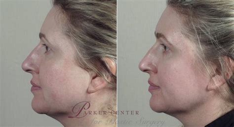 Nonsurgical Face Procedures Before And After Photo Gallery Paramus