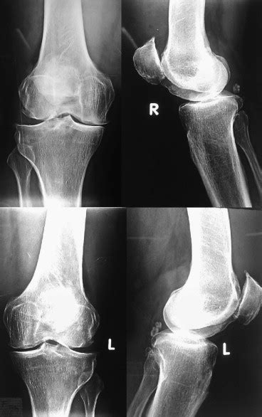 Bilateral Lipoma Arborescens With Osteoarthritis Knee Case Report And