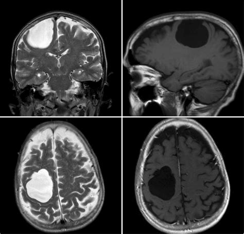 Upper Left Axial T2 Mri Shows A Hyperintense Cystic Mass Over Right