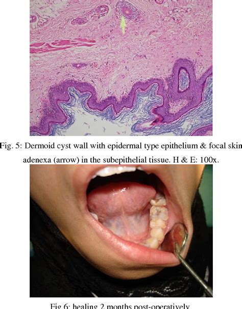 Figure 5 From Unilateral Dermoid Cyst Of The Floor Of The Mouth
