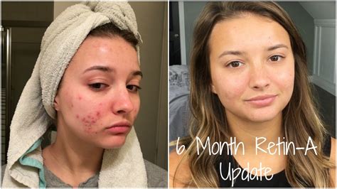 Retin A 6 Month Skin Update Jennybeyouty Youtube