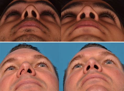 In the case of the following symptoms, the patient can use. Deviated Septum: Nose disease | National Pilot Newspaper