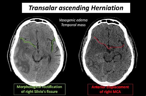Understanding Brain Herniations Semantic Scholar