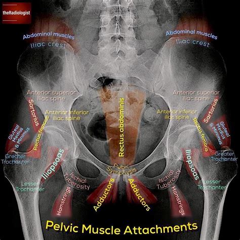 Agreements & disagreements workshop 36. Pelvic X-ray Anatomy #Ashiry - Radiology Students Of A.M.S ...