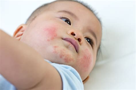 Baby Has An Allergic Reaction To The Face Skin Rashes In Babies Concept