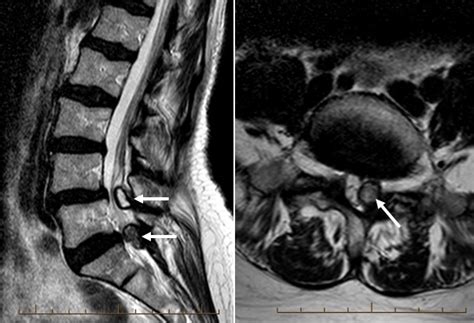 Lumbar Spine Facet Joint Synovial Cyst Radiology Mri