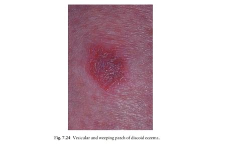 Discoid Nummular Eczema