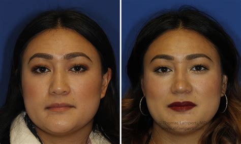 Thebrokensealblog Rhinoplasty For Wide Nose Before And After