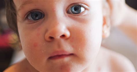 11 Signs You Should Get Your Childs Rash Checked Out