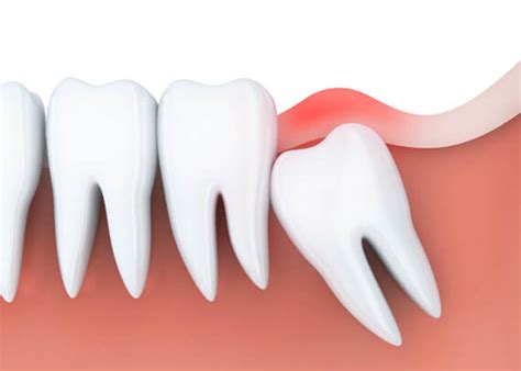 Wisdom Teeth Removal Call Or Text Definitive Dental