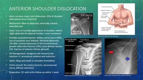 The reverse of the elevation movement. Anterior Shoulder Dislocation - ED Management The ...