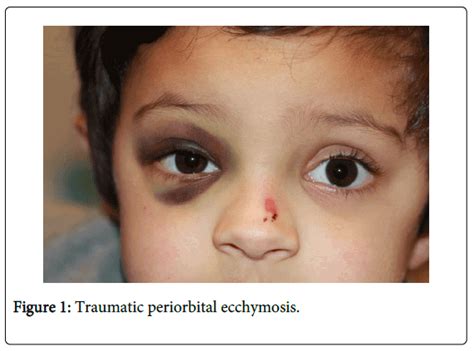 Clinical Experimental Ophthalmology Periorbital Ecchymosis