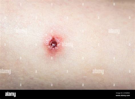 Blessure Déchirée De Linflammation Acné Sur La Peau Humaine Plaie