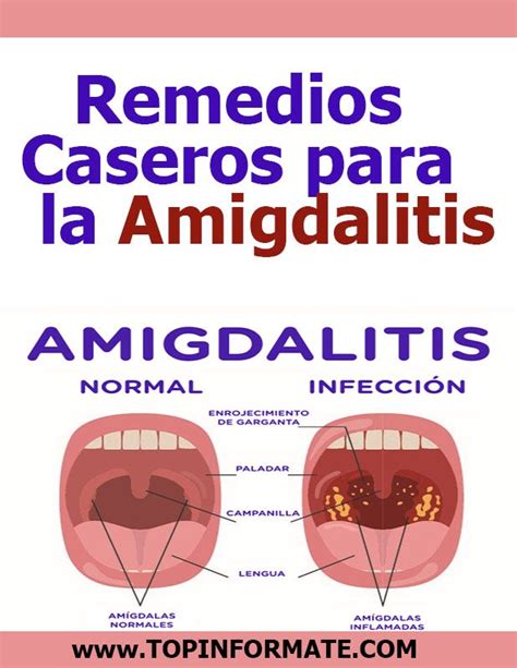 Remedios Caseros Para La Amigdalitis Remedies Caseros
