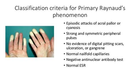 What Is Raynauds What Is Scleroderma