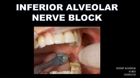 Inferior Alveolar Nerve Block Anatomical Landmarks