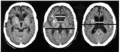 Ct Images Of The Brain Of A Patient With Tbi Measures Of Ventricular