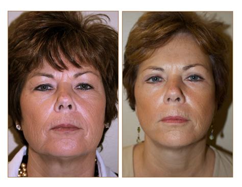 Pictures Face Lift facelift Lifestyle Lift Orlando ...
