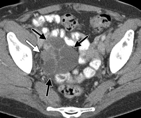 Fallopian Tube Disease In The Nonpregnant Patient Radiographics